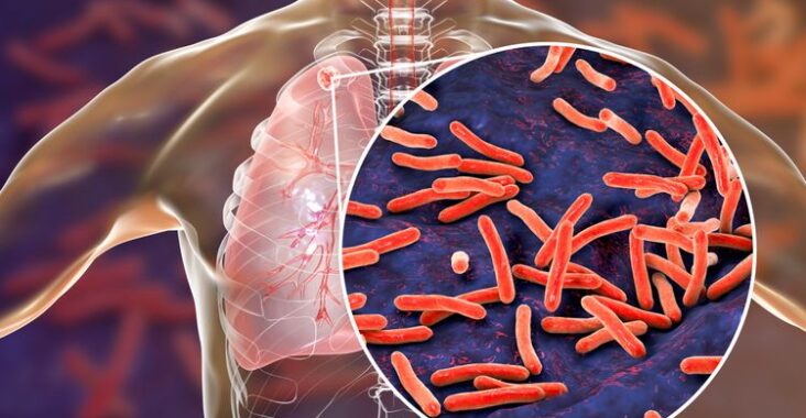 Tuberkulosis (TBC) : Jenis Gejala Dan Cara Pengobatannya